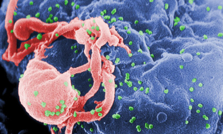 This undated photo provided by the Centers for Disease Control and Prevention shows a scanning electron micrograph of multiple round bumps of the HIV-1 virus on a cell surface. An 18-year-old French woman born with the AIDS virus has had her infection under control and nearly undetectable despite stopping treatment 12 years ago, an unprecedented remission, doctors are reporting, Monday, July 20, 2015. (Cynthia Goldsmith/Centers for Disease Control and Prevention via AP)